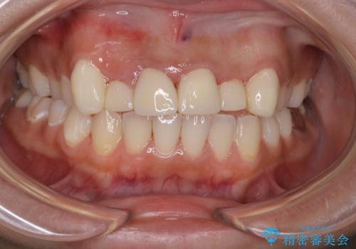 前歯をきれいにしたい、セラミック矯正の治療中