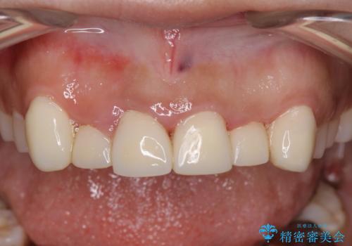 前歯をきれいにしたい、セラミック矯正の治療中