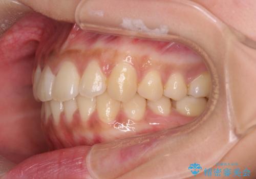 [ 歯を抜かないマウスピース矯正 ]  不揃いの目立つ前歯をきれいにしたいの治療後