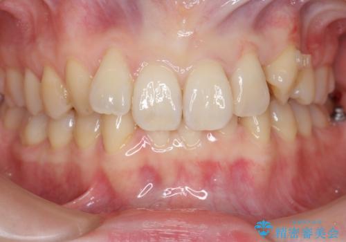 前歯のがたつき、八重歯 インビザラインで抜歯矯正の治療中