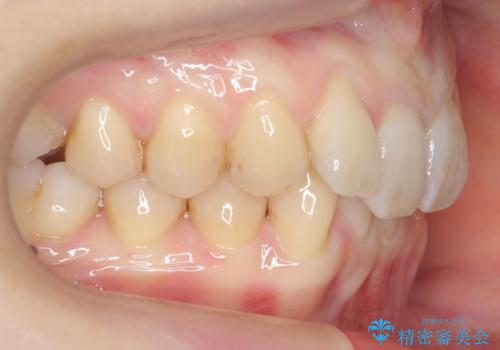 前歯のがたつき、八重歯　インビザラインで抜歯矯正の治療中