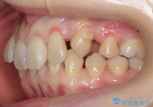 前歯のがたつき、八重歯 インビザラインで抜歯矯正の治療中