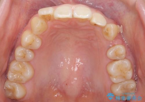 前歯のがたつき、八重歯 インビザラインで抜歯矯正の治療中