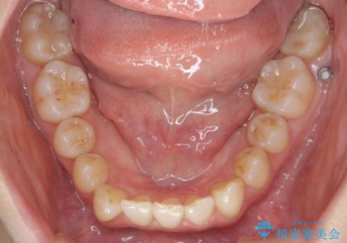 前歯のがたつき、八重歯 インビザラインで抜歯矯正の治療中