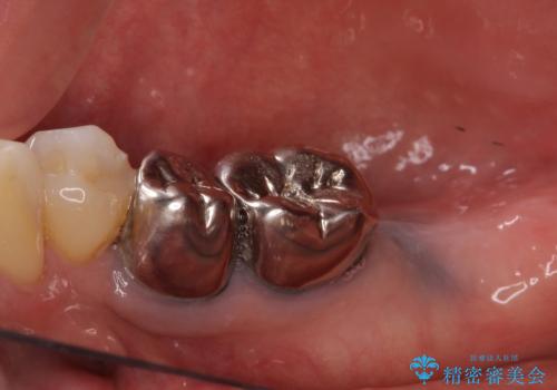 欠損した奥歯のインプラント補綴治療の治療前