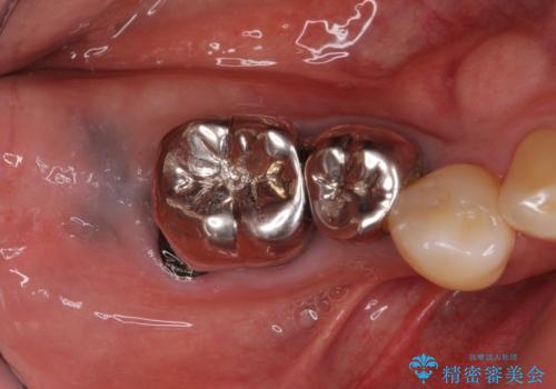 欠損した奥歯のインプラント補綴治療の症例 治療前