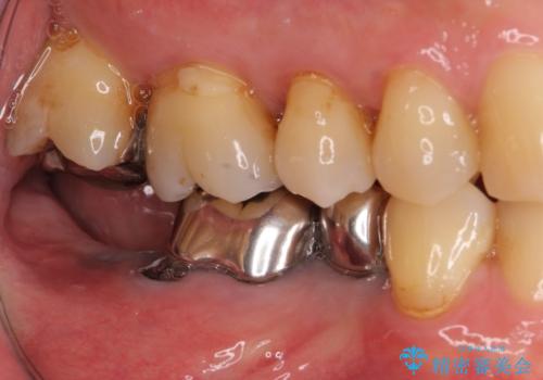 欠損した奥歯のインプラント補綴治療の治療前