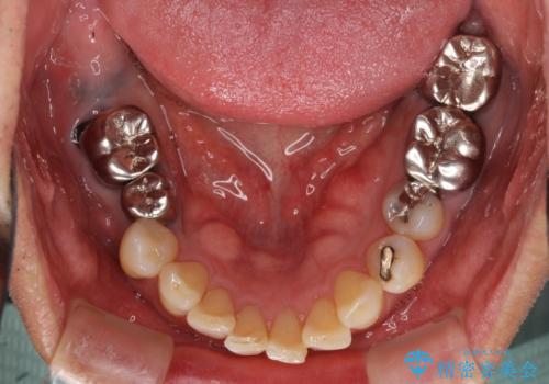 欠損した奥歯のインプラント補綴治療の治療前