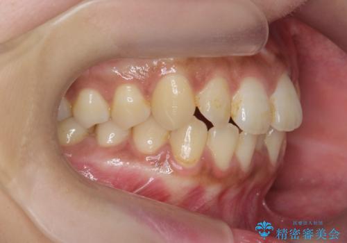 [ 歯を抜かないマウスピース矯正 ]  不揃いの目立つ前歯をきれいにしたいの治療前