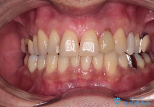 根管治療の土台のまま放置してしまった前歯　オールセラミッククラウンによる補綴治療の治療前