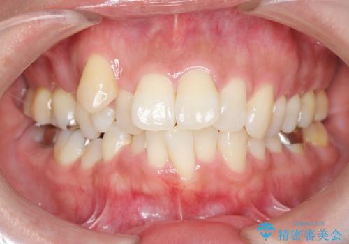 職業柄ワイヤー矯正ができない、マウスピース矯正で行う八重歯抜歯症例の治療前