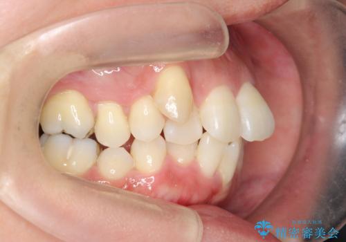 職業柄ワイヤー矯正ができない、マウスピース矯正で行う八重歯抜歯症例の治療前