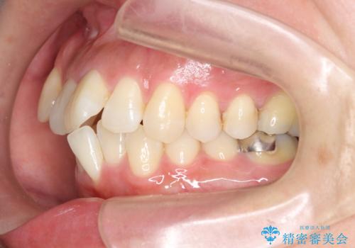 職業柄ワイヤー矯正ができない、マウスピース矯正で行う八重歯抜歯症例の治療前