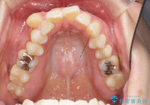 職業柄ワイヤー矯正ができない、マウスピース矯正で行う八重歯抜歯症例の治療前