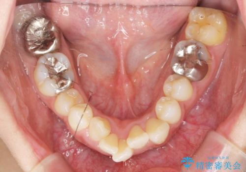 職業柄ワイヤー矯正ができない、マウスピース矯正で行う八重歯抜歯症例の治療前