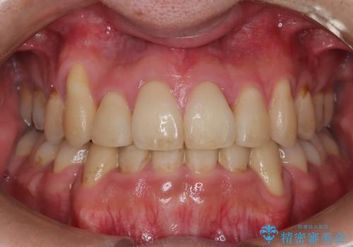 ガタガタの歯並び、八重歯をなおしたい、骨格性下顎前突　カモフラージュ矯正の治療後