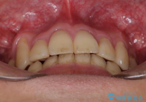 ガタガタの歯並び、八重歯をなおしたい、骨格性下顎前突 カモフラージュ矯正の治療後