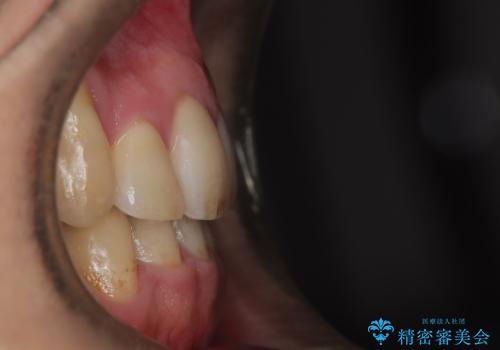 ガタガタの歯並び、八重歯をなおしたい、骨格性下顎前突 カモフラージュ矯正の治療後