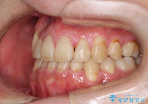 ガタガタの歯並び、八重歯をなおしたい、骨格性下顎前突 カモフラージュ矯正の治療後