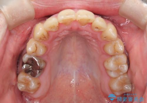ガタガタの歯並び、八重歯をなおしたい、骨格性下顎前突 カモフラージュ矯正の治療後