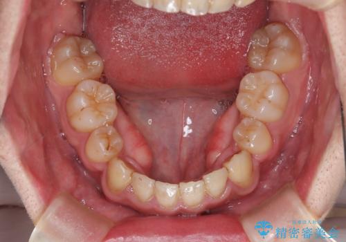 ガタガタの歯並び、八重歯をなおしたい、骨格性下顎前突 カモフラージュ矯正の治療後