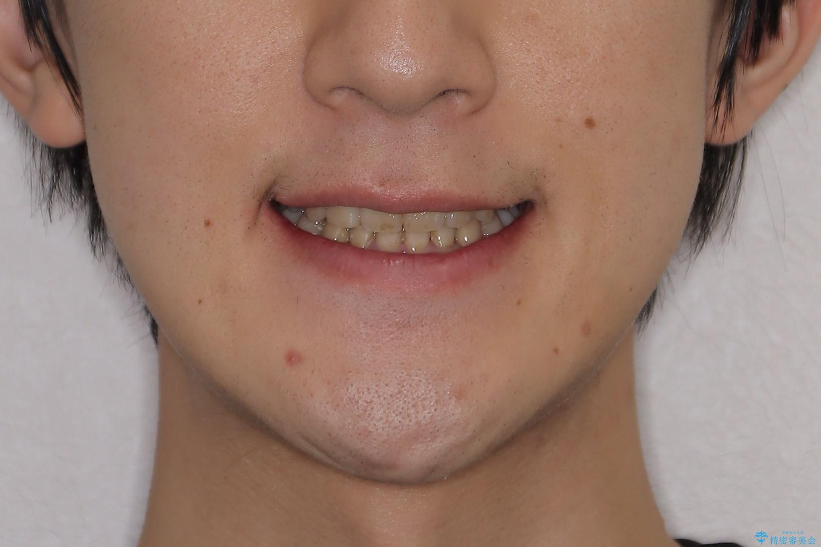 ガタガタの歯並び、八重歯をなおしたい、骨格性下顎前突　カモフラージュ矯正の治療後（顔貌）