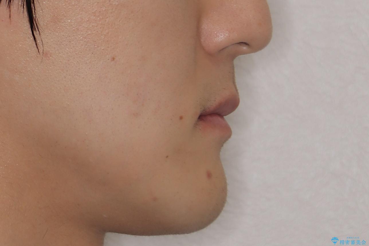 ガタガタの歯並び、八重歯をなおしたい、骨格性下顎前突 カモフラージュ矯正の治療後(顔貌)