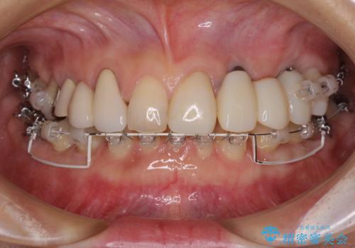 割れてしまった歯が痛む 矯正とインプラントを併用した総合歯科治療の治療中