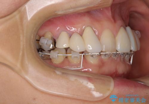 割れてしまった歯が痛む 矯正とインプラントを併用した総合歯科治療の治療中