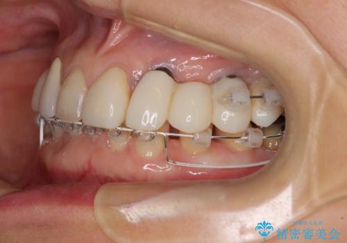 割れてしまった歯が痛む　矯正とインプラントを併用した総合歯科治療の治療中
