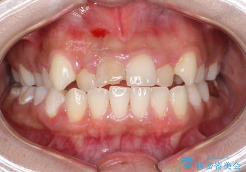 前歯をきれいにしたい、セラミック矯正の治療前