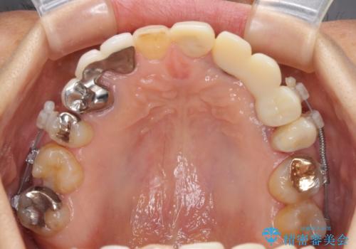 割れてしまった歯が痛む　矯正とインプラントを併用した総合歯科治療の治療中