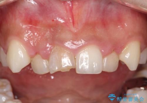 前歯をきれいにしたい、セラミック矯正の治療前