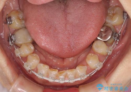割れてしまった歯が痛む 矯正とインプラントを併用した総合歯科治療の治療中