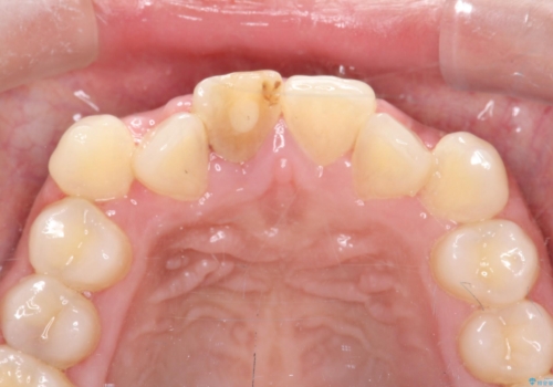 前歯をきれいにしたい、セラミック矯正の治療前