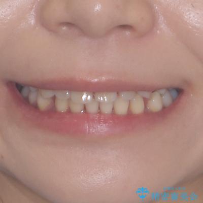 隙間の多い歯並びをインビザラインで矯正治療の治療後（顔貌）