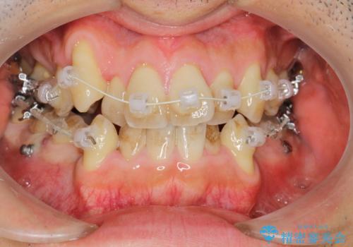 ガタガタの歯並び、八重歯をなおしたい、骨格性下顎前突　カモフラージュ矯正の治療中