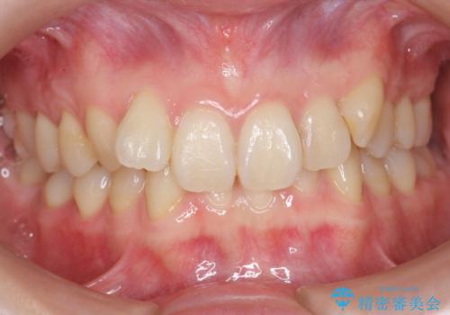 前歯のがたつき、八重歯　インビザラインで抜歯矯正の症例 治療前