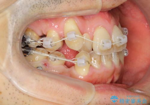 ガタガタの歯並び、八重歯をなおしたい、骨格性下顎前突 カモフラージュ矯正の治療中