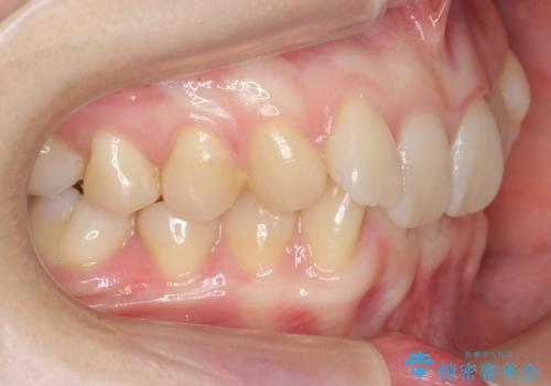 前歯のがたつき、八重歯 インビザラインで抜歯矯正の治療前