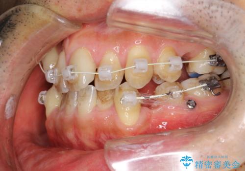 ガタガタの歯並び、八重歯をなおしたい、骨格性下顎前突　カモフラージュ矯正の治療中
