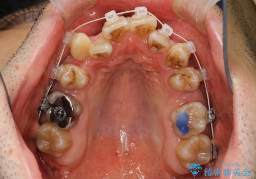 ガタガタの歯並び、八重歯をなおしたい、骨格性下顎前突 カモフラージュ矯正の治療中