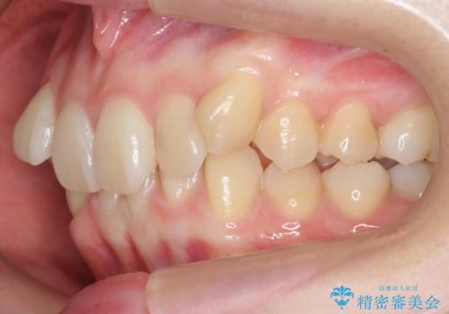 前歯のがたつき、八重歯　インビザラインで抜歯矯正の治療前
