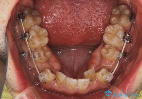 ガタガタの歯並び、八重歯をなおしたい、骨格性下顎前突 カモフラージュ矯正の治療中