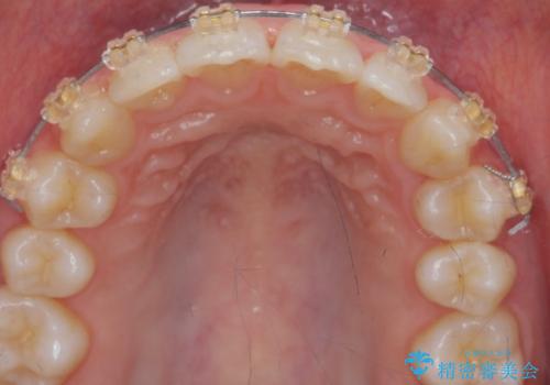 [ 鋏状咬合・過蓋咬合・上顎前突 ]  前歯のガタつき、噛みあわせのズレを矯正治療で改善の治療中