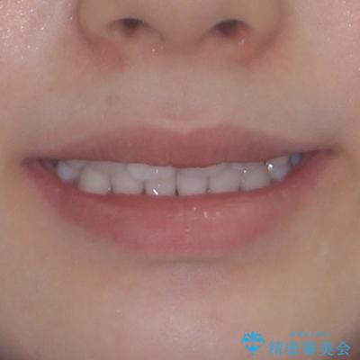 前歯のデコボコとクロスバイトを治したい　ワイヤー装置による抜歯矯正の治療後（顔貌）