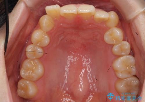 前歯のがたつき、八重歯 インビザラインで抜歯矯正の治療前