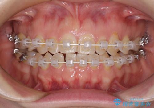 隙間の空いた歯列とボロボロの乳歯 インプラント治療と矯正治療の治療中