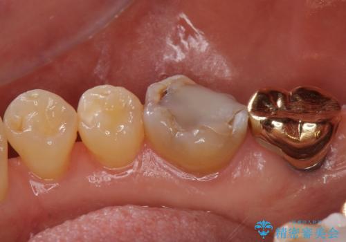 虫歯の治療 できれば歯の向きも変えたいの治療前