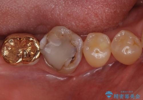 虫歯の治療　できれば歯の向きも変えたいの症例 治療前